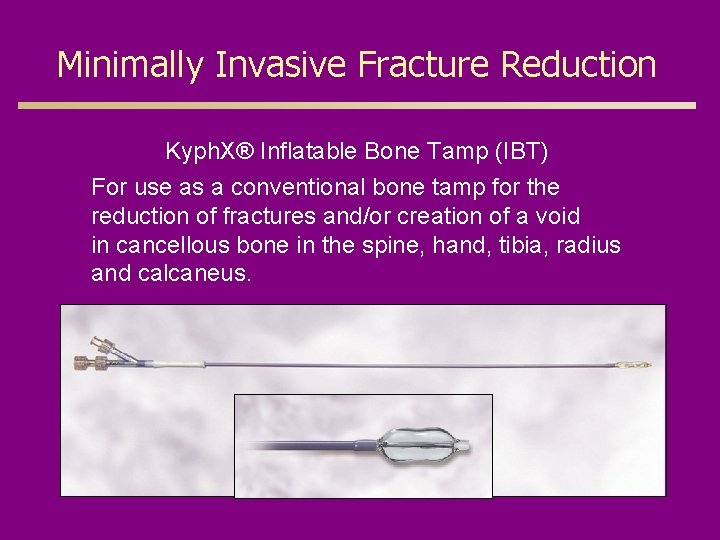 Minimally Invasive Fracture Reduction Kyph. X® Inflatable Bone Tamp (IBT) For use as a
