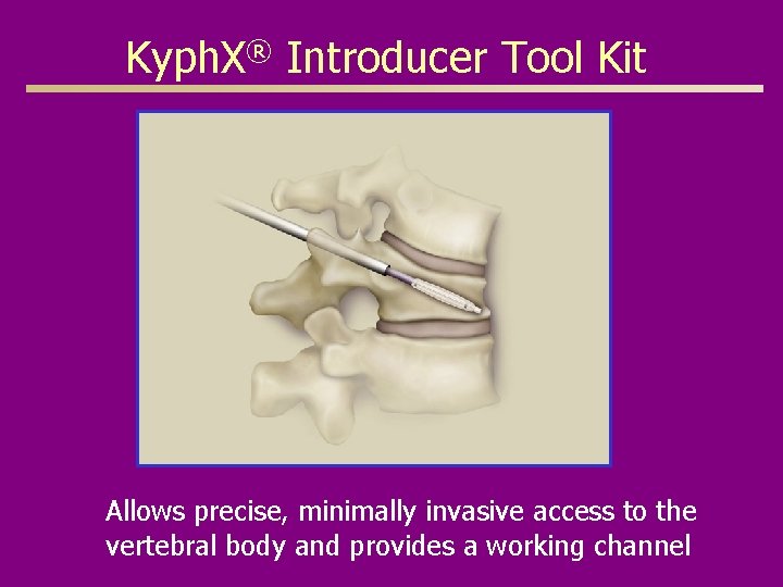 Kyph. X® Introducer Tool Kit Allows precise, minimally invasive access to the vertebral body