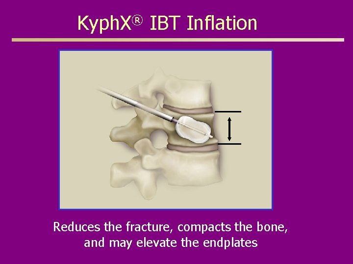 Kyph. X® IBT Inflation Reduces the fracture, compacts the bone, and may elevate the
