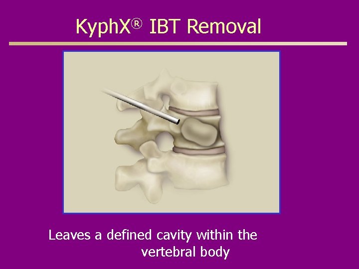 Kyph. X® IBT Removal Leaves a defined cavity within the vertebral body 
