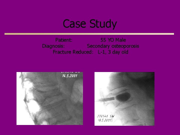 Case Study Patient: 55 YO Male Diagnosis: Secondary osteoporosis Fracture Reduced: L-1, 3 day