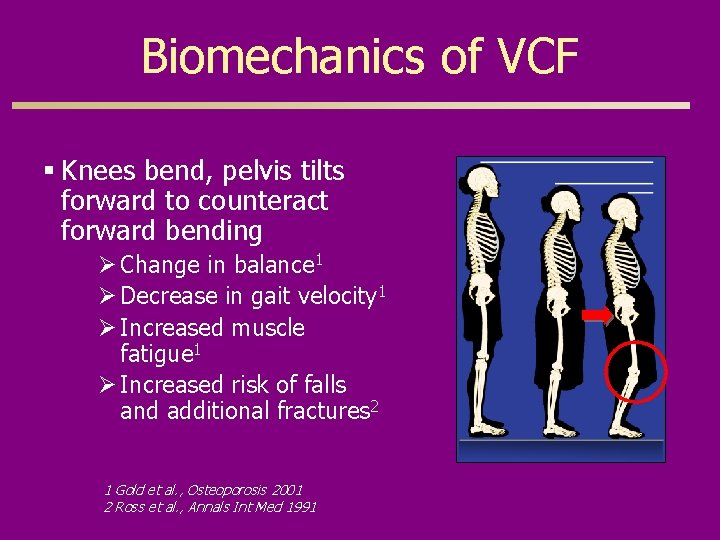 Biomechanics of VCF § Knees bend, pelvis tilts forward to counteract forward bending Ø