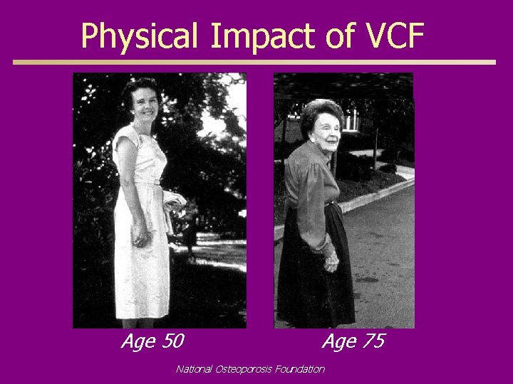 Physical Impact of VCF Age 50 Age 75 National Osteoporosis Foundation 