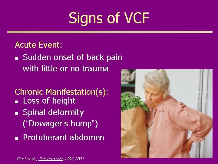 Signs of VCF Acute Event: n Sudden onset of back pain with little or