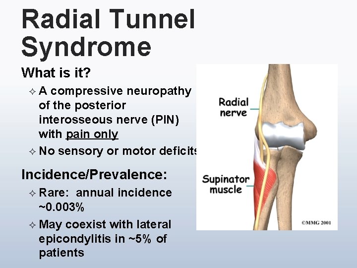 Radial Tunnel Syndrome What is it? ²A compressive neuropathy of the posterior interosseous nerve