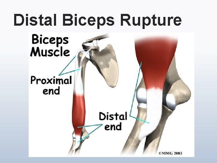 Distal Biceps Rupture 