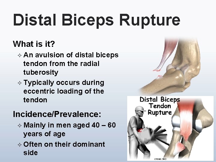 Distal Biceps Rupture What is it? ² An avulsion of distal biceps tendon from