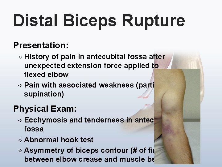 Distal Biceps Rupture Presentation: ² History of pain in antecubital fossa after unexpected extension