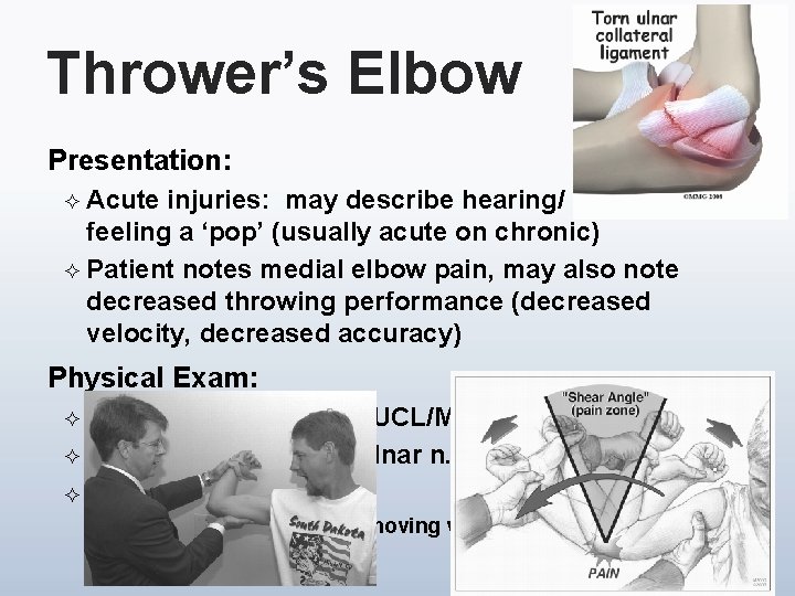 Thrower’s Elbow Presentation: ² Acute injuries: may describe hearing/ feeling a ‘pop’ (usually acute