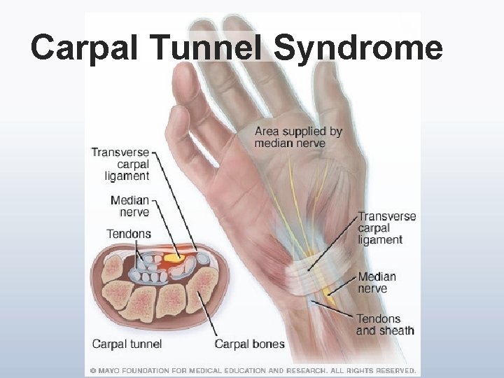 Carpal Tunnel Syndrome 