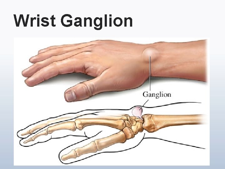 Wrist Ganglion 