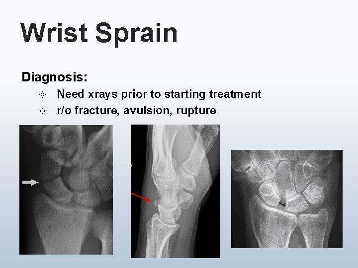 Wrist Sprain Diagnosis: ² ² Need xrays prior to starting treatment r/o fracture, avulsion,