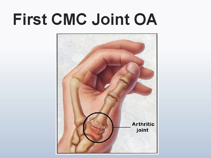 First CMC Joint OA 