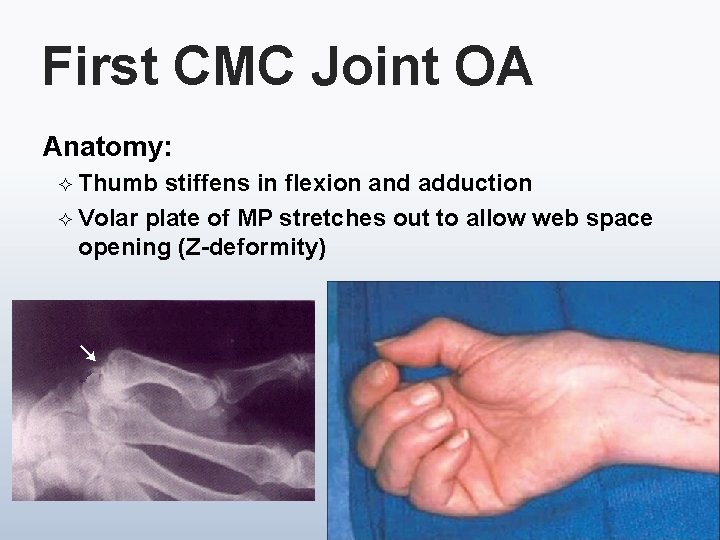 First CMC Joint OA Anatomy: ² Thumb stiffens in flexion and adduction ² Volar