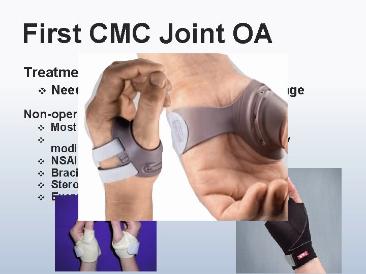 First CMC Joint OA Treatment options v Need to get radiographs to assess stage