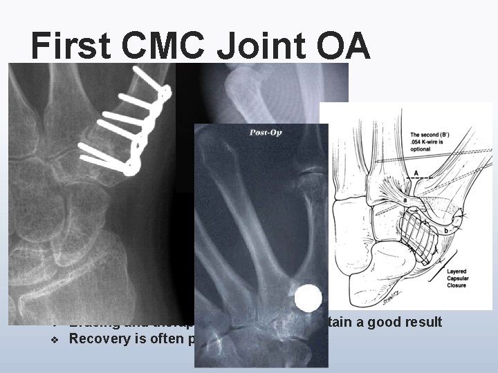 First CMC Joint OA Operative: Failure of conservative measures v Early v v v