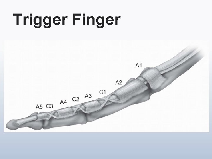 Trigger Finger 
