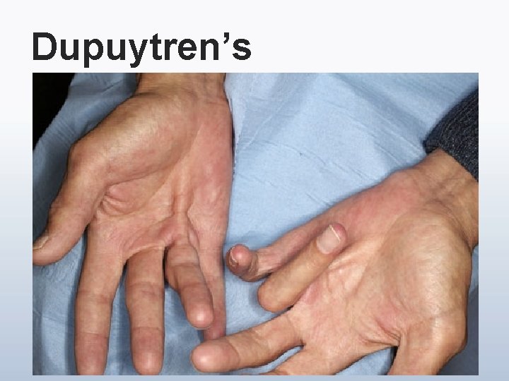 Dupuytren’s 