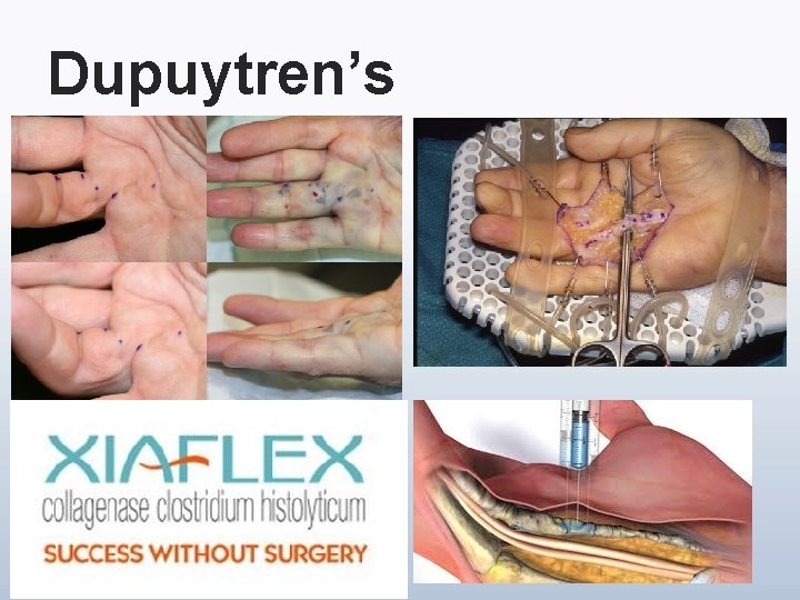 Dupuytren’s 