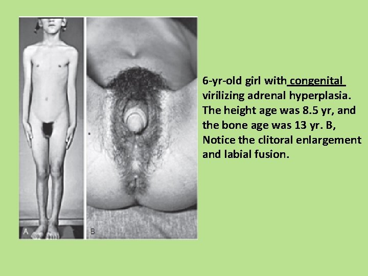 6 -yr-old girl with congenital virilizing adrenal hyperplasia. The height age was 8. 5