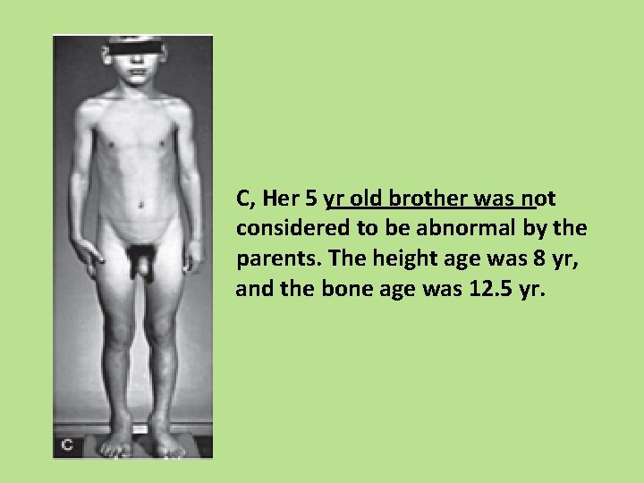 C, Her 5 yr old brother was not considered to be abnormal by the