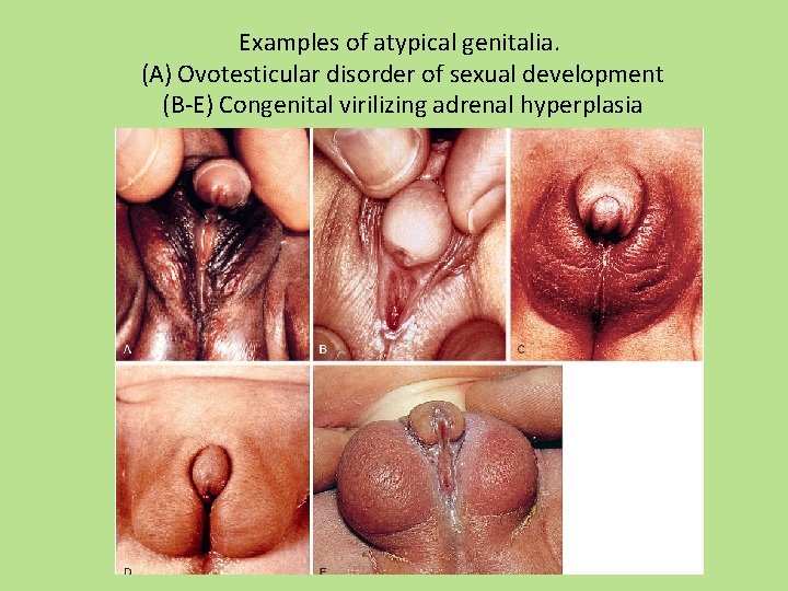 Examples of atypical genitalia. (A) Ovotesticular disorder of sexual development (B-E) Congenital virilizing adrenal