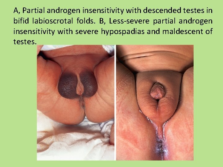A, Partial androgen insensitivity with descended testes in bifid labioscrotal folds. B, Less-severe partial