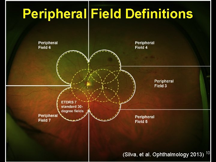 Peripheral Field Definitions (Silva, et al. Ophthalmology 2013) 10 