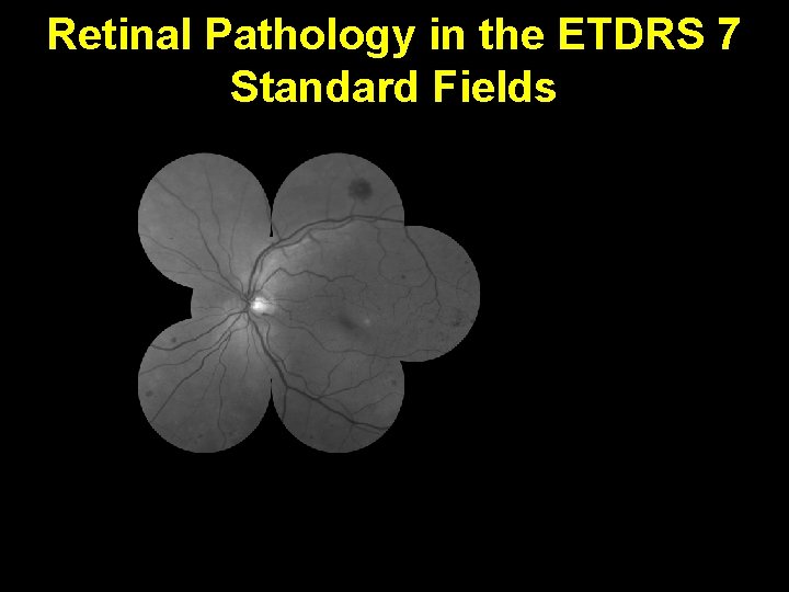 Retinal Pathology in the ETDRS 7 Standard Fields 