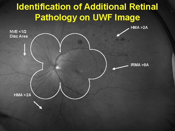 Identification of Additional Retinal Pathology on UWF Image NVE <1/2 Disc Area HMA >2