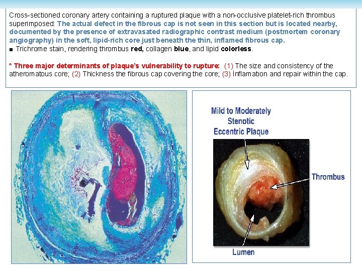 Cross-sectioned coronary artery containing a ruptured plaque with a non-occlusive platelet-rich thrombus superimposed: The