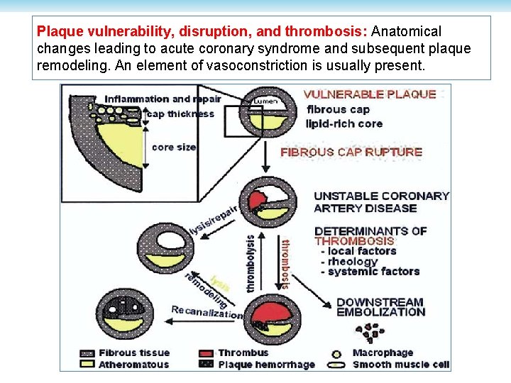 Plaque vulnerability, disruption, and thrombosis: Anatomical changes leading to acute coronary syndrome and subsequent