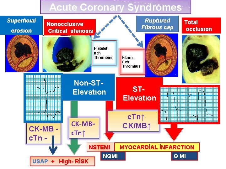 Acute Coronary Syndromes Superfıcıal erosıon Ruptured Fibrous cap Nonocclusıve Critical stenosıs Plateletrich Thrombus Non-STElevatıon