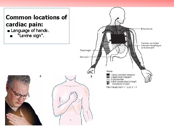 Common locations of cardiac pain: ■ Language of hands. ■ “Levine sign”. 