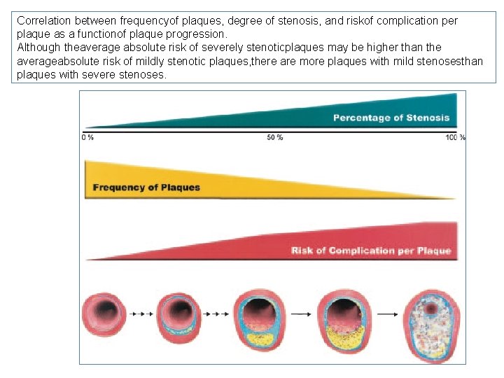 Correlation between frequencyof plaques, degree of stenosis, and riskof complication per plaque as a