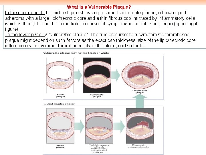 Ø What Is a Vulnerable Plaque? In the upper panel, the middle figure shows