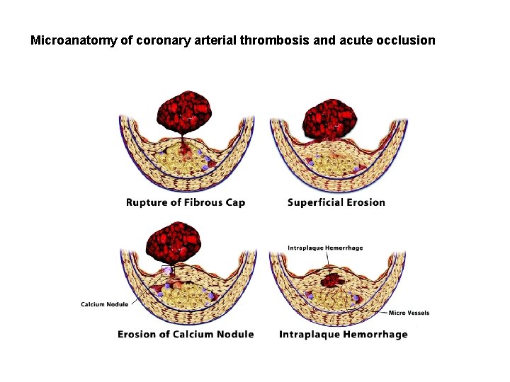 Microanatomy of coronary arterial thrombosis and acute occlusion 
