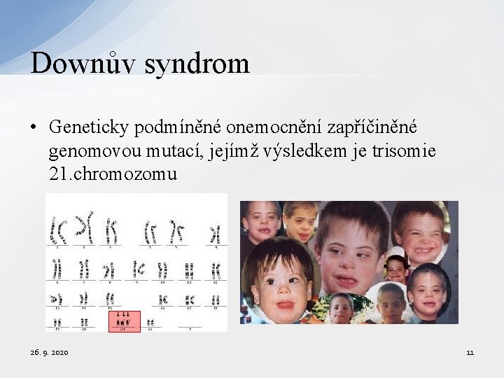 Downův syndrom • Geneticky podmíněné onemocnění zapříčiněné genomovou mutací, jejímž výsledkem je trisomie 21.