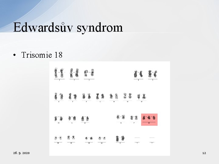 Edwardsův syndrom • Trisomie 18 26. 9. 2020 12 