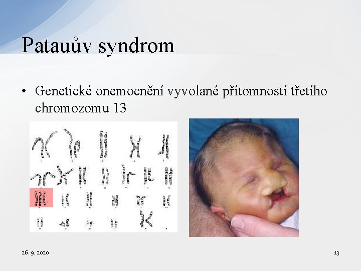 Patauův syndrom • Genetické onemocnění vyvolané přítomností třetího chromozomu 13 26. 9. 2020 13