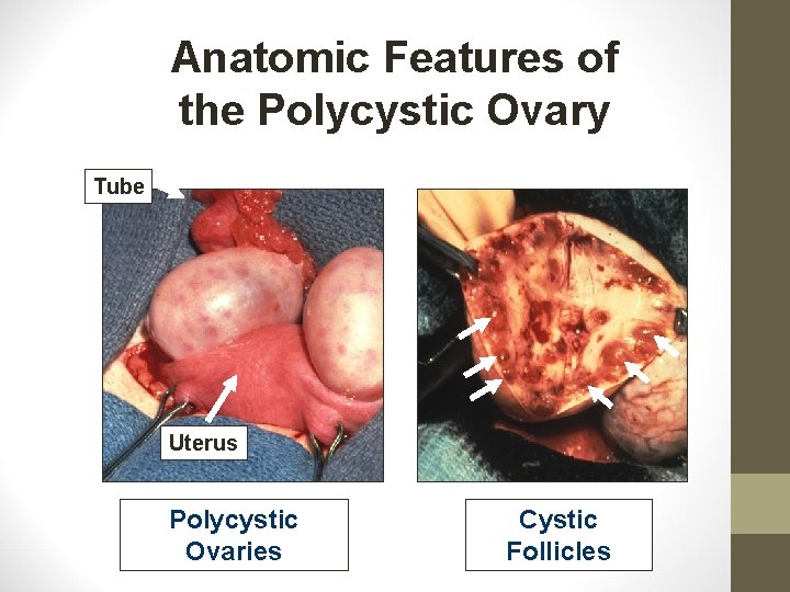 Anatomic Features of the Polycystic Ovary Tube Uterus Polycystic Ovaries Cystic Follicles 