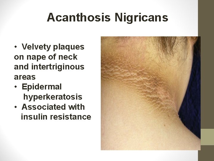 Acanthosis Nigricans • Velvety plaques on nape of neck and intertriginous areas • Epidermal