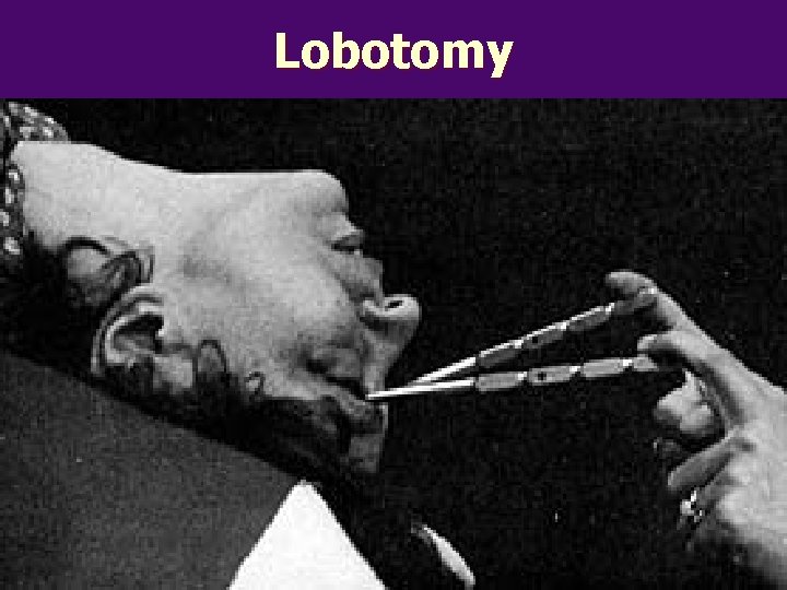 Lobotomy n 