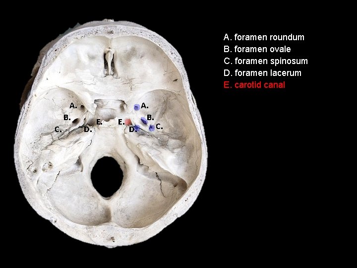A. foramen roundum B. foramen ovale C. foramen spinosum D. foramen lacerum E. carotid