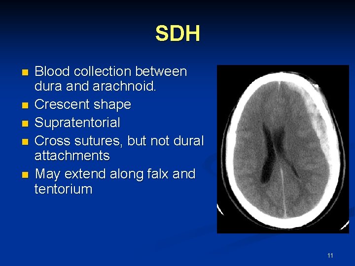 SDH n n n Blood collection between dura and arachnoid. Crescent shape Supratentorial Cross