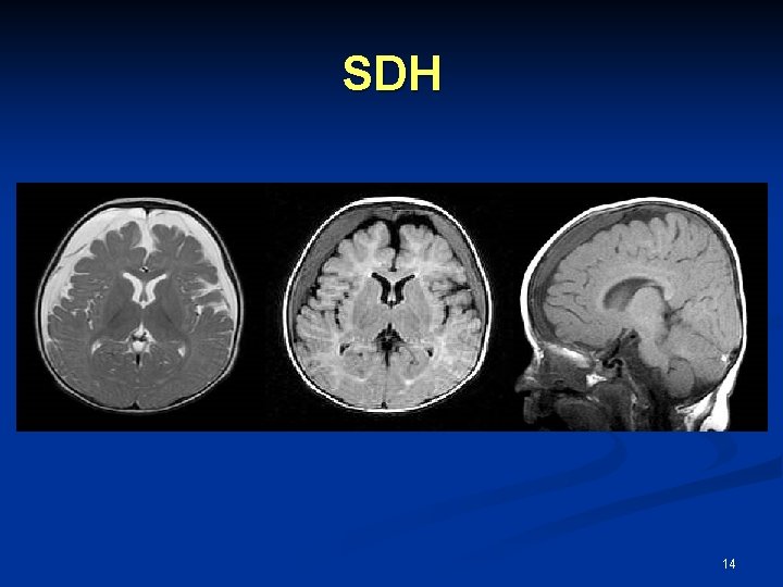 SDH 14 