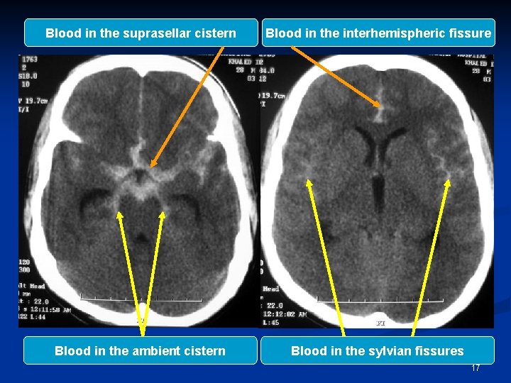 Blood in the suprasellar cistern Blood in the interhemispheric fissure Blood in the ambient