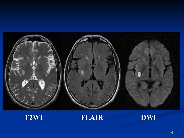 T 2 WI FLAIR DWI 40 