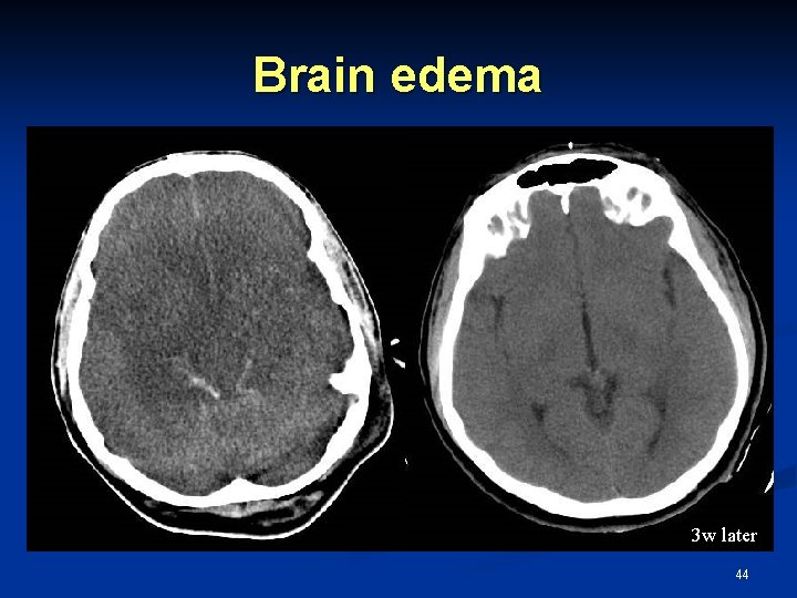 Brain edema 3 w later 44 