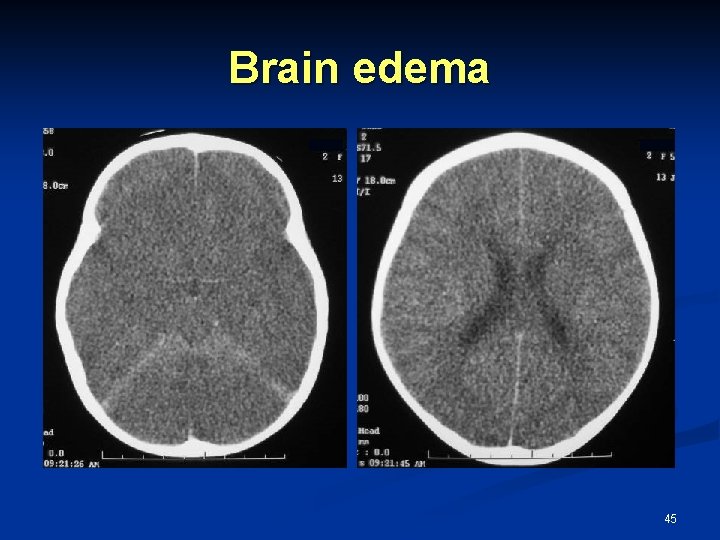 Brain edema 45 